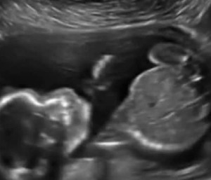 ecografia in care bebelusul isi da singur un pumn