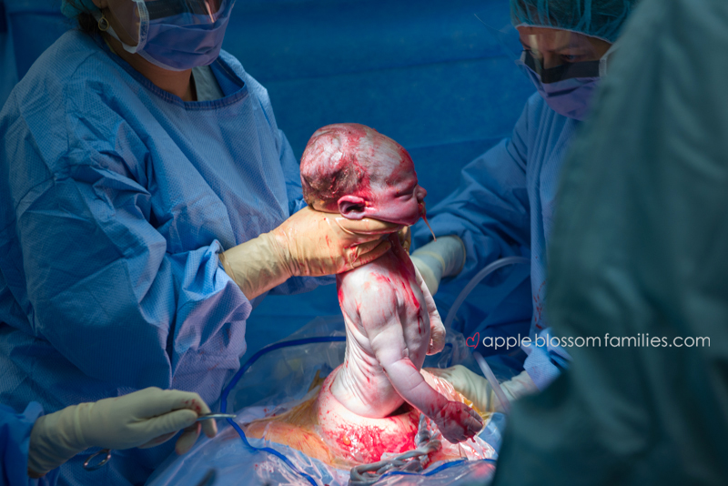 nasterea prin cezariana