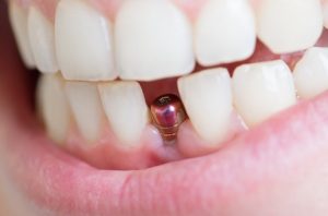 Ce trebuie să știi despre implantul dentar