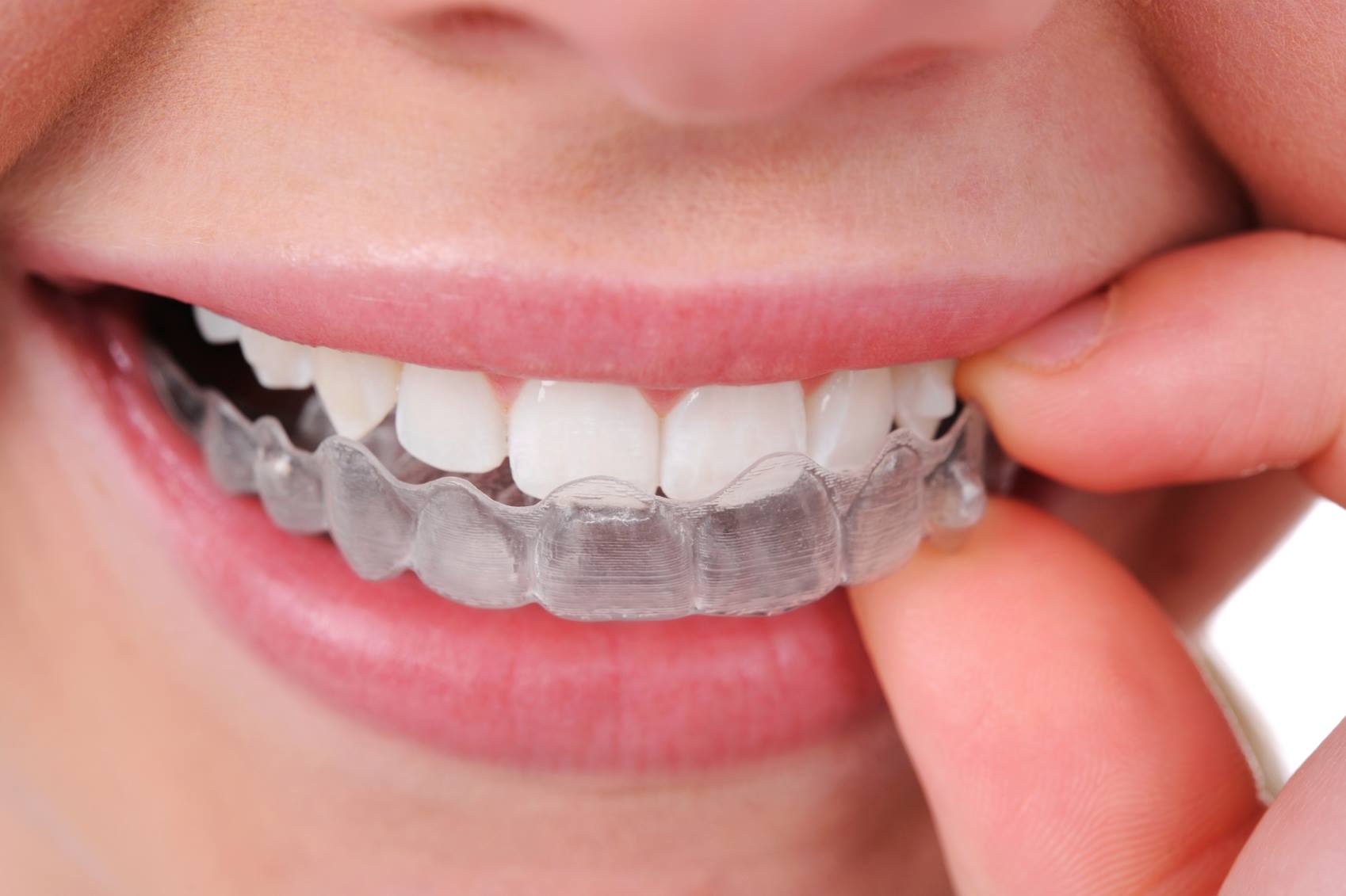 Ce-probleme-rezolvă-tratamentul-cu-Invisalign
